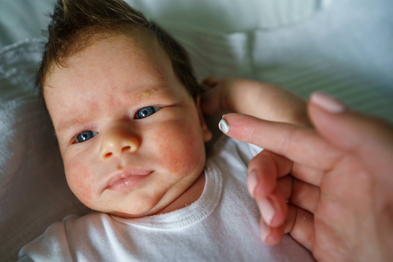 Baby met een huidprobleem op het gezicht en de hand van een vrouw met een verzorgende crème die wordt aangebracht terwijl de baby ligt